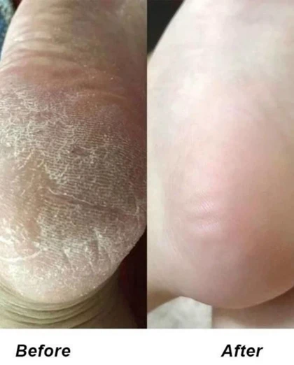اسپری لایه بردار ترک پا راکو RAKO