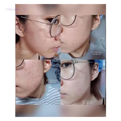 سرم آبرسان سنتلا ماداگاسکار Skin1004 مدل آمپول