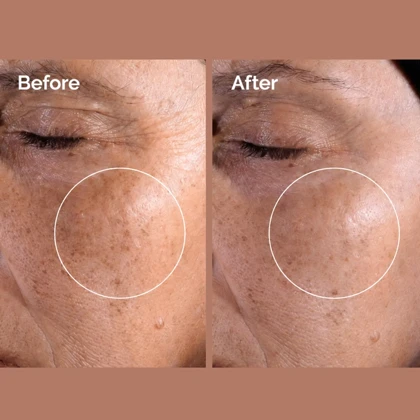تونر گلیکولیک اسید 7% اوردینری Ordinary لایه بردار و شفاف کننده مناسب انواع پوست