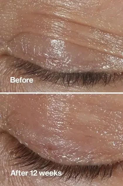 کرم دور چشم ضد چروک کلینیک (Clinique)