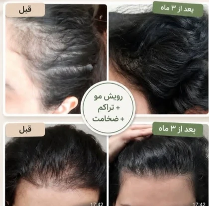 پک اکونومی رویش مجدد مو هیرفرند و بیز و شامپو مورینگا اکسونیک