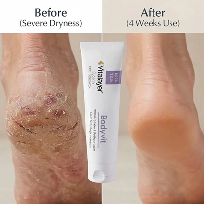 کرم دست و صورت اوسرین و اوره 10 درصد ویتالیر Bodyvit مناسب پوست خشک و زبر 100ML