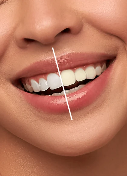 سفید کننده دندان مدل Vi-ONE