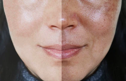 کرم ضد لک قوی سیسپرسا حاوی ٪5 سیستئامین 50 میل