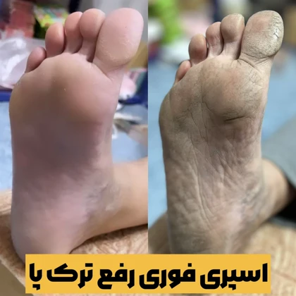 اسپری لایه بردار ترک پا راکو RAKO