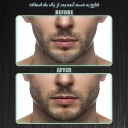 زاویه ساز فک رادیس فیت مدل Full Weight بسته شش عددی