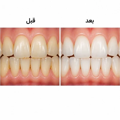 پکیج سرم سفید کننده دندان لانبنا + مسواک برقی شیائومی مدل X3 قابل شارژ ضدآب
