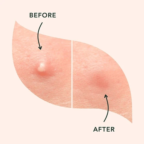 پچ ضدجوش و آکنه اورژانسی کورمسیک 36 عددی