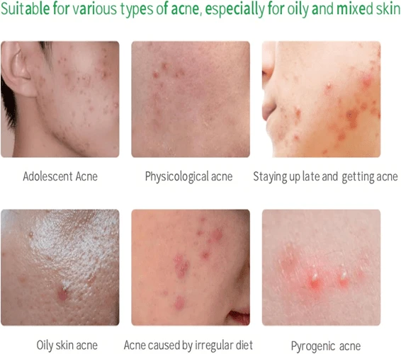 پچ ضدجوش و آکنه اورژانسی کورمسیک 36 عددی