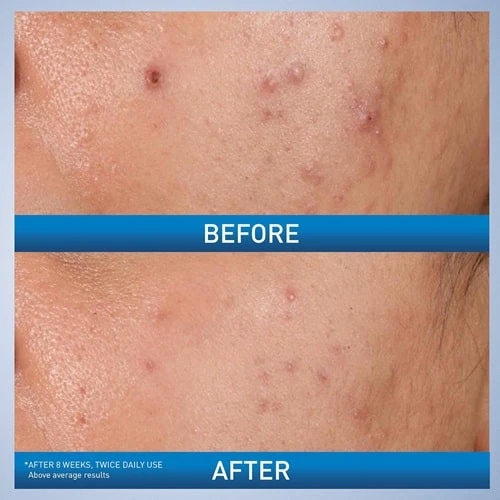 ژل آبرسان ضد جوش سراوی 40 میل